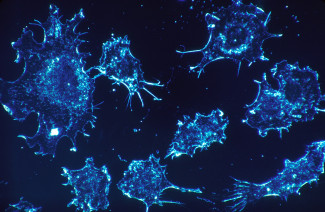 Cancer cells_microscopy