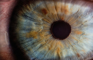 Eye ocular melanoma