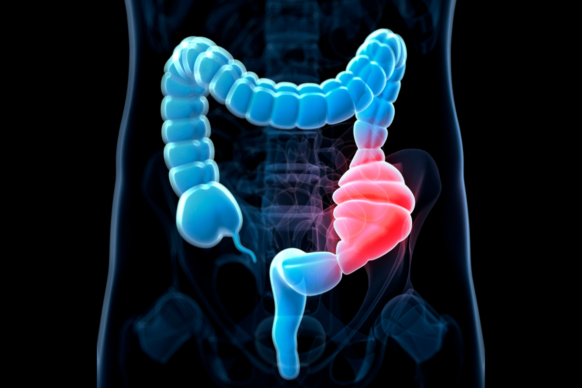 Imagen colon con una parte inflamada